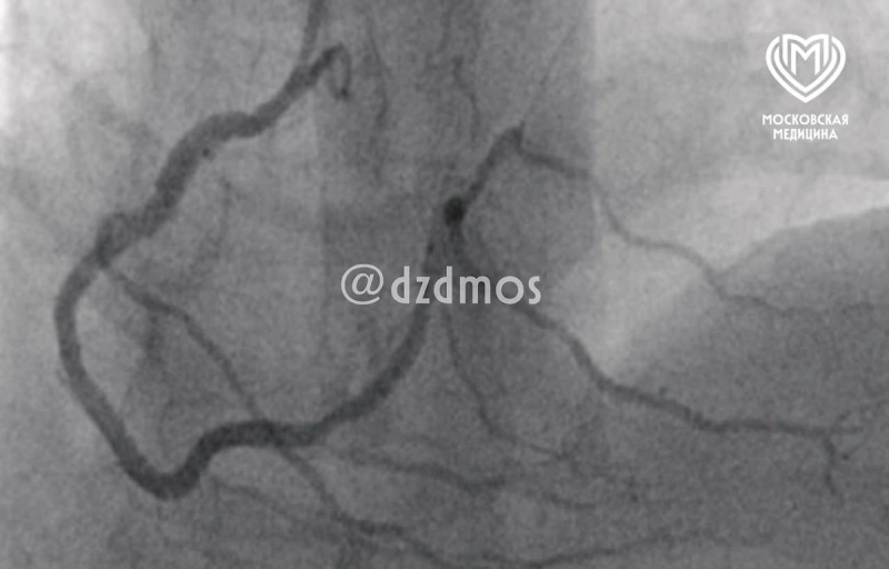 Москвича чуть не убил инфаркт из-за страшной аллергии на свинину