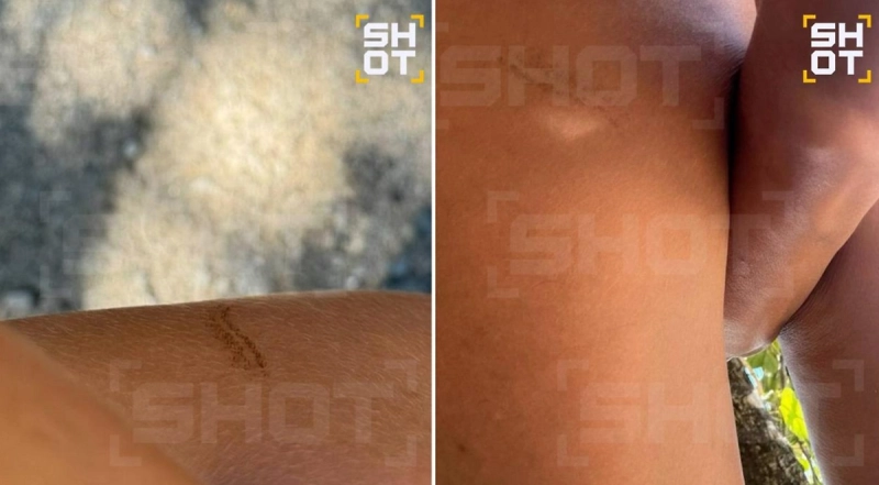 «Гламурная» ядовитая гусеница ужалила российскую туристку в ягодицу в Таиланде