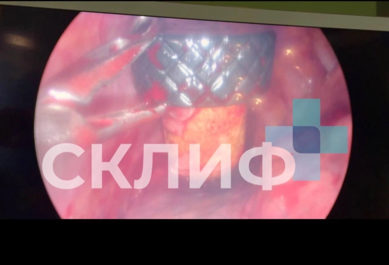 Россиянин поехал кататься на снегоходе с бутылкой коньяка под курткой и чуть не погиб