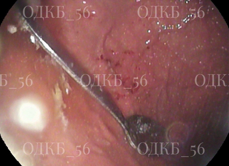 В Оренбурге врачи спасли ребёнка с 14-сантиметровой ложкой в желудке